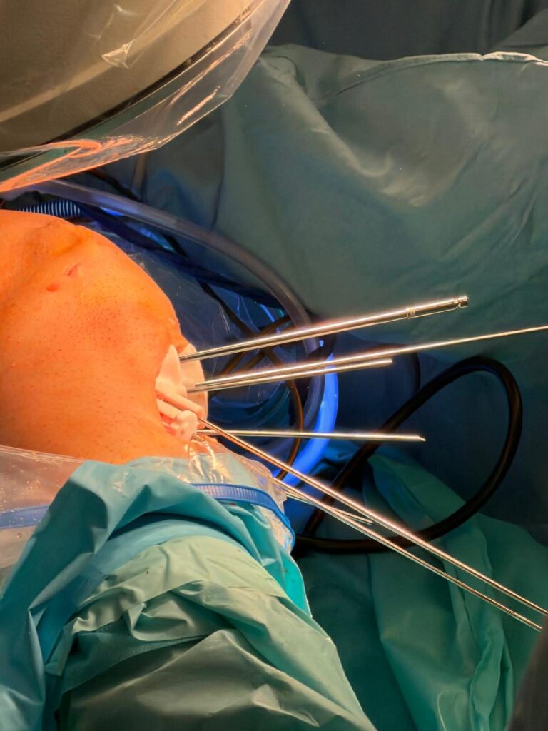 Dzięki modelowi 3D, ortopedzi uratowali kolano 26-letniej tancerki